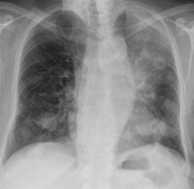 Chest radiograph in a patient with squamous cell c