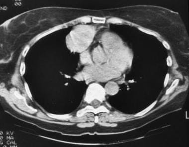 Thymoma. CT scan shows a homogeneous thymic mass. 