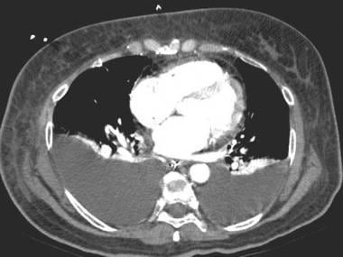 Computed tomography scan in a patient with suspect