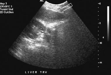 Transverse view, real-time ultrasonogram shows an 