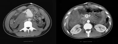 Axial contrast-enhanced CT scans of the same patie