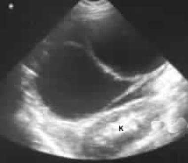 Sonogram přes levé hypochondrium ukazuje la