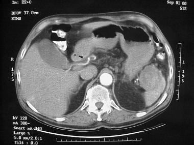 CT scan of a patient with a pancreatic pseudocyst 