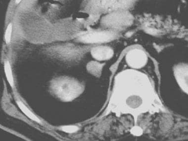 Contrast-enhanced axial CT scan. A right adrenal a