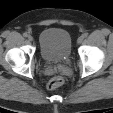 Nonenhanced CT image of the pelvis shows a small a