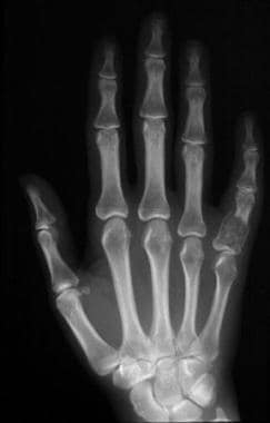 Frontal radiograph of the left hand demonstrates a