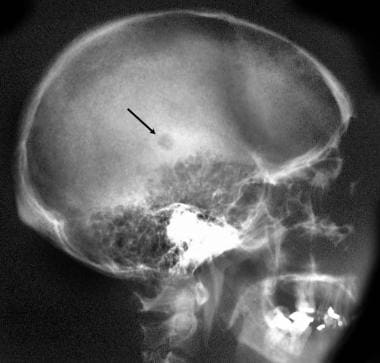Plain radiograph of the skull of a 39-year-old wom