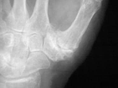 Radiograph demonstrates narrowing and osteophytosi