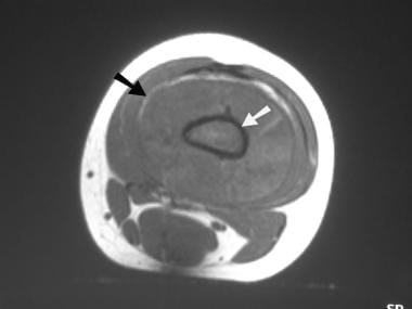 Osteosarcoma. Axial T1-weighted MRI. The abnormal 