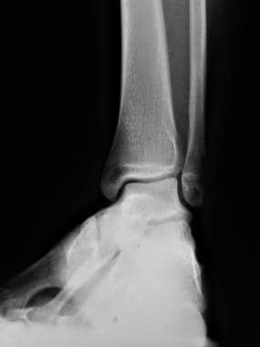 Radiograph of the lower extremity of the 3-year-ol