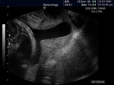 Transvaginal sonogram shows a short (about 2 to 3 