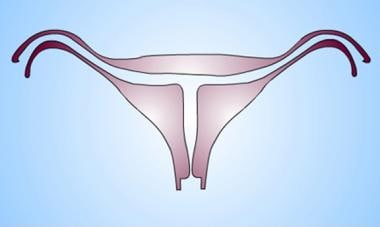 Uterus, müllerian duct abnormalities. Diethylstilb