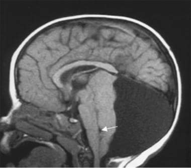 A posterior fossa arachnoid cyst in a 15-month-old