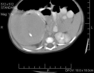 Axial image in a 3-month-old infant with a palpabl