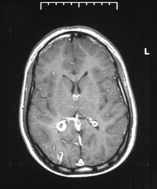 Axial T1-weighted gadolinium-enhanced MRI through 