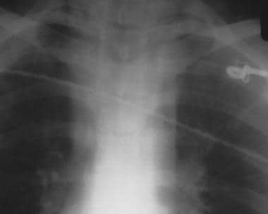 Aorta, trauma. Chest radiograph shows a focal isth