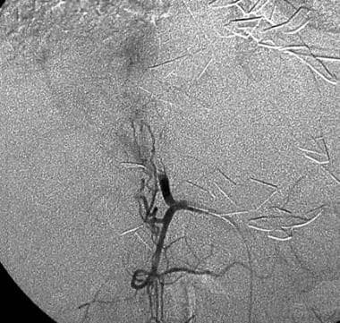 Hepatic artery postembolization arteriogram in a 2