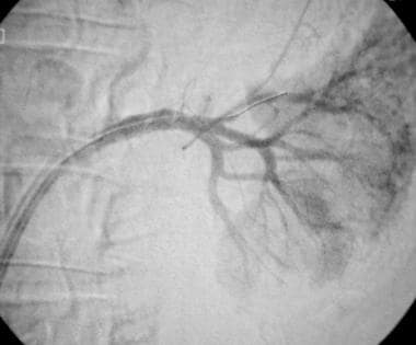Post–stent-graft deployment left renal angiogram (