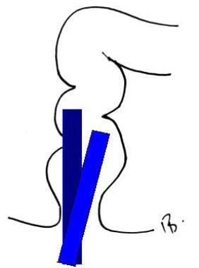 Maneuvering through rectal valves. 