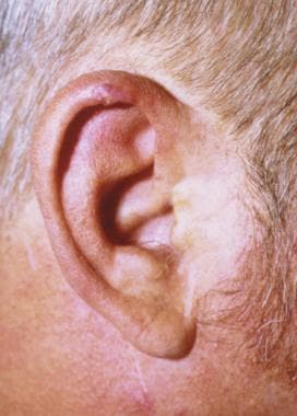 cancerous tumor behind ear