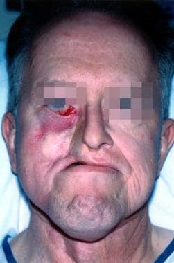 This patient, who underwent previous free flap clo
