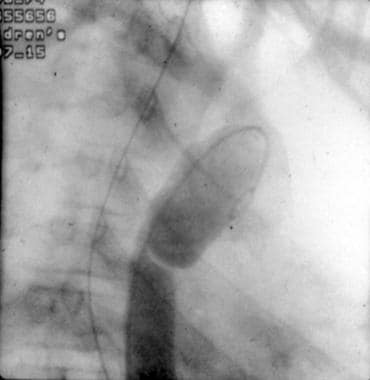 Pediatric Thoracic Trauma. Lateral aortograph show