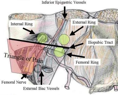 Laparoscopic Inguinal Hernia Repair: Background, Indications,  Contraindications