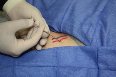 Femoral artery cannulation (Seldinger). Puncture o