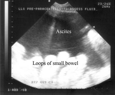 Ultrasonogram showing ascites.