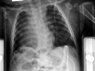 A chest radiograph of a 10-month-old child after r