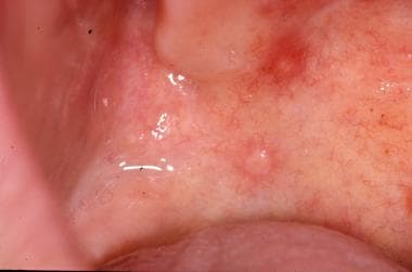 mucocele floor of mouth