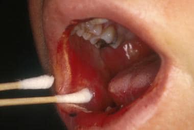 Erythematous oral mucositis lesion on the buccal m