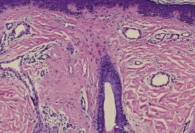 Histopathologic features of a capillary malformati