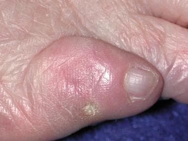 Tinea pedis interdigital type - Altmeyers Encyclopedia - Department  Dermatology