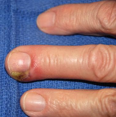 Candidiasis of the skin and nails: Symptoms, treatment, and prevention