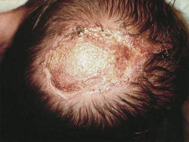 Extensive aplasia cutis congenita on the scalp, ex