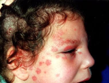 Multiple lesions on the face caused by Microsporum