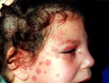 Tinea manuum caused by Microsporum canis. The patient presented with a