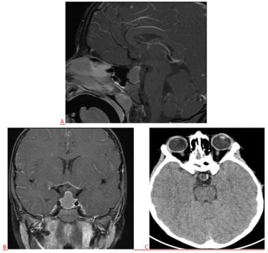 T1-weighted MRI with gadolinium in sagittal (A) an