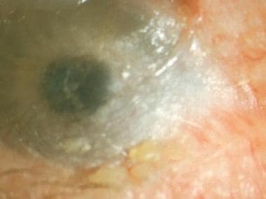 Ocular cicatricial pemphigoid, stage IV. Note the 