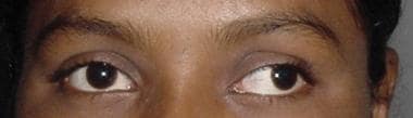 Patient with intermittent exotropia at both distan