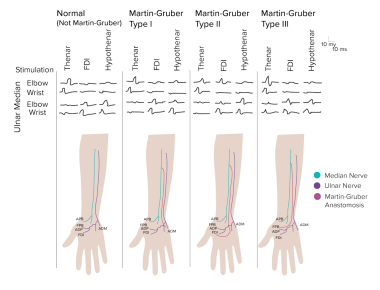 Anatomy In Motion - Median Nerve Entrapment by Medscape The median