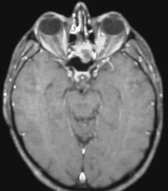 Axial MRI taken 3 weeks after the onset of distort