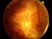 Diabetic Retinopathy