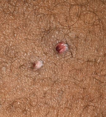 Forensic Pathology of Firearm Wounds: Overview, Modern Ammunition ...