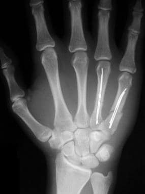 AP radiograph of 4th and 5th metacarpal fractures 