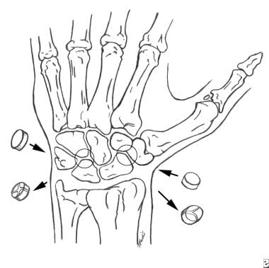Wrist arthrodesis. Position of dowel grafts for sc