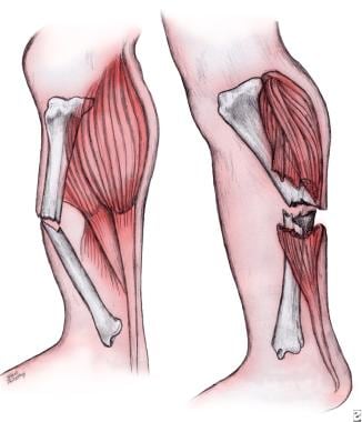 Thin shaft-rings from cattle-size tibia and metatarsus diaphyses.