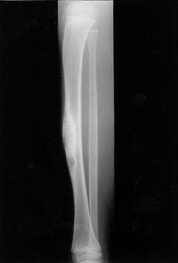 Radiograph of osteofibrous dysplasia of tibia in 5
