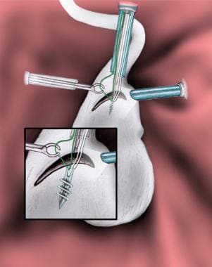 The suture limbs are passed through the labrum. Ei